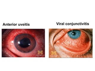 Viral conjunctivitisAnterior uveitis
 