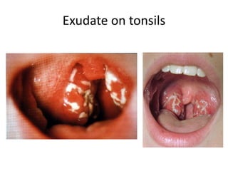 Exudate on tonsils
 