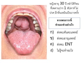 หากพบภาวะนี้
ท่านจะทาอย่างไร
ก) ส่งพบทันตะแพทย์
ข) ส่งพบอายุแพทย์
ค) ส่งพบ ENT
ง) ไม่รู้จะทาอะไร
หญิงอายุ 30 ปี คลาได้ก้อน
ที่เพดานปาก 1 สัปดาห์ ไม่
ปวด มีกลิ่นเหม็นเป็นบางครั้ง
 
