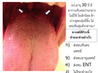ผป.อายุ 30 ปี มี
อาการเจ็บคอปานกลาง
ไม่มีไข้ ไอเล็กน้อย อ้า
ปากดูพบตุ่มที่ลิ้น ไม่
เคยเห็นตุ่มดังกล่าวมา
ก่อนหากพบภาวะนี้
ท่านจะทาอย่างไร
ก) ส่งพบทันตะ
แพทย์
ข) ส่งพบอายุแพทย์
ค) ส่งพบ ENT
 