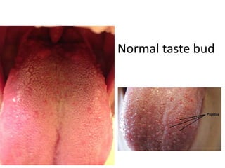 Normal taste bud
 