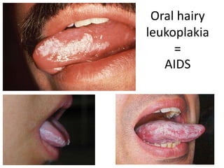 Oral hairy
leukoplakia
=
AIDS
 