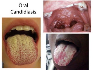 Oral
Candidiasis
 