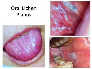 Oral Lichen
Planus
 