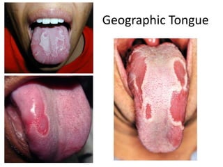 Geographic Tongue
 