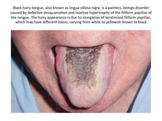 Black hairy tongue, also known as lingua villosa nigra, is a painless, benign disorder
caused by defective desquamation and reactive hypertrophy of the filiform papillae of
the tongue. The hairy appearance is due to elongation of keratinized filiform papillae,
which may have different colors, varying from white to yellowish brown to black
 