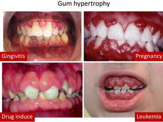 Gum hypertrophy
Drug induce Leukemia
Gingivitis Pregnancy
 