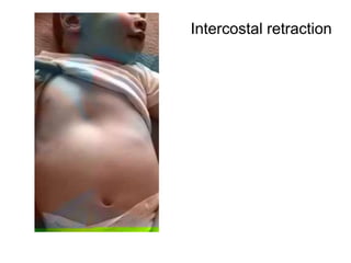 Intercostal retraction
 