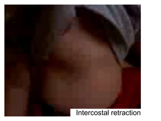 Intercostal retraction
 