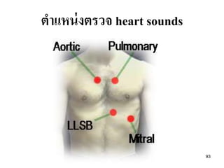 93
ตาแหน่งตรวจ heart sounds
 