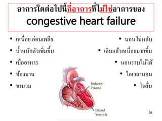อาการใดต่อไปนี้กี่อาการที่ไม่ใช่อาการของ
congestive heart failure
• เหนื่อย อ่อนเพลีย
• น้ำหนักตัวเพิ่มขึ้น
• เบื่ออำหำร
• ท้องมำน
• ขำบวม
• นอนไม่หลับ
• เดินแล้วเหนื่อยมำกขึ้น
• นอนรำบไม่ได้
• ไอเวลำนอน
• ใจสั่น
98
 