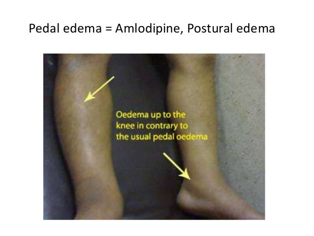 Slsi Lk How Long For Sulfatrim To Work Your Can Amlodipine Cause Pitting Edema Spending