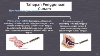 21
Tahapan Penggunaan
Cunam
Tipe Pemasangan Cunam
Pemasangan pelvik
(melintang terhadap panggul),
iaiah pemasangan cunam di
mana sumbu panjang cunam
sesuai dengan sumbu panggul.
○ Pemasangan sefalik (pemasangan biparietal,
melintang terhadap kepala), ialah pemasangan cunam
dimana sumbu panjang cunam sesuai dengan
diameter mento-oksiptalis kepala janin sehingga
daun cunam terpasang secara simetrik di kiri kanan
kepala.
 