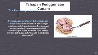 22
Tahapan Penggunaan
Cunam
Tipe Pemasangan Cunam
○ Pemasangan sefalopelvik/Pemasangan
Sempurna ketika kriteria baik pemasangan
kepala dan pelvik sudah sesuai. Pemasangan
sempurna adalah dengan presentasi OA,
ketika oksiput sudah memutar, tepat berada
simfisis pubis, dan sutura sagital tepat berada
diameter AP.
 