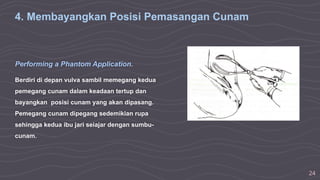 24
4. Membayangkan Posisi Pemasangan Cunam
Performing a Phantom Application.
Berdiri di depan vulva sambil memegang kedua
pemegang cunam dalam keadaan tertup dan
bayangkan posisi cunam yang akan dipasang.
Pemegang cunam dipegang sedemikian rupa
sehingga kedua ibu jari seiajar dengan sumbu-
cunam.
 