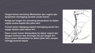 27
○ Tangan kanan penolong dikeluarkan dari vagina dan
bergantian memegang sendok cunam kanan.
○ Ketiga jari tangan kiri penolong dimasukkan ke dalam
vagina antara kepala dan jalan lahir.
○ Cunam kanan dipegang seperti memegang pensil dan
sejajar lipatan paha depan kiri.
○ Daun cunam kanan dimasukkan ke dalam vagina dan
dengan tuntunan dan dorongan ibu jari tangan kiri
daun cunam dimasukkan ke dalam jalan lahir sampai
setinggi puncak kepala
 
