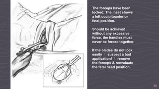 30
The forceps have been
locked. The inset shows
a left occipitoanterior
fetal position.
Should be achieved
without any excessive
force, the handles must
never be forced together.
If the blades do not lock
easily  suspect a bad
application!  remove
the forceps & reevaluate
the fetal head position.
 