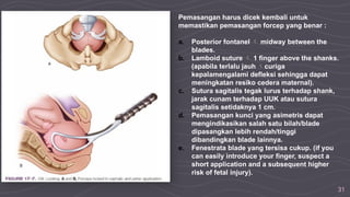 31
Pemasangan harus dicek kembali untuk
memastikan pemasangan forcep yang benar :
a. Posterior fontanel  midway between the
blades.
b. Lamboid suture  1 finger above the shanks.
(apabila terlalu jauh curiga
kepalamengalami defleksi sehingga dapat
meningkatan resiko cedera maternal).
c. Sutura sagitalis tegak lurus terhadap shank,
jarak cunam terhadap UUK atau sutura
sagitalis setidaknya 1 cm.
d. Pemasangan kunci yang asimetris dapat
mengindikasikan salah satu bilah/blade
dipasangkan lebih rendah/tinggi
dibandingkan blade lainnya.
e. Fenestrata blade yang tersisa cukup. (if you
can easily introduce your finger, suspect a
short application and a subsequent higher
risk of fetal injury).
 