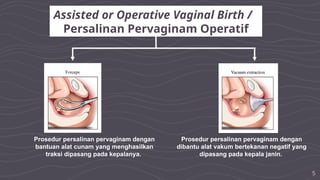 5
Assisted or Operative Vaginal Birth /
Persalinan Pervaginam Operatif
Prosedur persalinan pervaginam dengan
bantuan alat cunam yang menghasilkan
traksi dipasang pada kepalanya.
Prosedur persalinan pervaginam dengan
dibantu alat vakum bertekanan negatif yang
dipasang pada kepala janin.
 