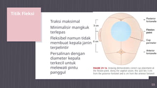 Titik Fleksi
59
Traksi maksimal
Minimalisir mangkuk
terlepas
Fleksibel namun tidak
membuat kepala janin
terpelintir
Persalinan dengan
diameter kepala
terkecil untuk
melewati pintu
panggul
 