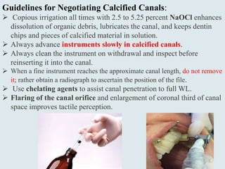 Guidelines for Negotiating Calcified Canals:
 Copious irrigation all times with 2.5 to 5.25 percent NaOCl enhances
dissolution of organic debris, lubricates the canal, and keeps dentin
chips and pieces of calcified material in solution.
 Always advance instruments slowly in calcified canals.
 Always clean the instrument on withdrawal and inspect before
reinserting it into the canal.
 When a fine instrument reaches the approximate canal length, do not remove
it; rather obtain a radiograph to ascertain the position of the file.
 Use chelating agents to assist canal penetration to full WL.
 Flaring of the canal orifice and enlargement of coronal third of canal
space improves tactile perception.
 