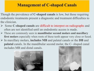 Management of C-shaped Canals
Though the prevalence of C-shaped canals is low, but those requiring
endodontic treatments present a diagnostic and treatment difficulties to
the clinician.
 Some C-shaped canals are difficult to interpret on radiographs and
often are not identified until an endodontic access is made.
 These are commonly seen in mandibular second molars and maxillary
first molars especially when roots of these teeth appear very close or fused.
 In maxillary molars, includes MB and palatal canals or the DB and
palatal canals. In the mandibular second molar, the C- shaped canal
includes MB and distal canals.
 