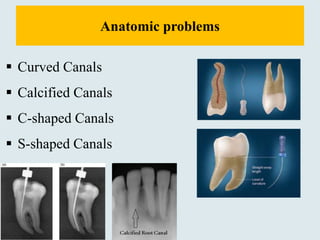 Anatomic problems
 Curved Canals
 Calcified Canals
 C-shaped Canals
 S-shaped Canals
 
