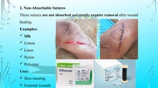 2. Non-Absorbable Sutures
These sutures are not absorbed and usually require removal after wound
healing.
Examples:
 Silk
 Cotton
 Linen
 Nylon
 Polyester
Uses:
 Skin suturing
 External wounds
 
