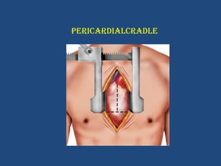 PERICARDIALCRADLE   