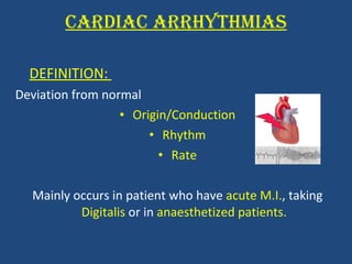 CARDIAC ARRHYTHMIAS DEFINITION:  Deviation from normal  Origin/Conduction Rhythm Rate Mainly occurs in patient who have  acute M.I. , taking  Digitalis  or in  anaesthetized patients. 