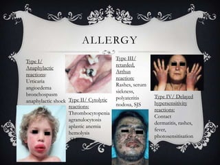 ALLERGY
Type I/
Anaphylactic
reactions:
Urticaria
angioedema
bronchospasm
anaphylactic shock Type II/ Cytolytic
reactions:
Thrombocytopenia
agranulocytosis
aplastic anemia
hemolysis
SLE

Type III/
retarded,
Arthus
reaction:
Rashes, serum
sickness,
polyateritis
nodosa, SJS

Type IV/ Delayed
hypersensitivity
reactions:
Contact
dermatitis, rashes,
fever,
photosensitisation

 