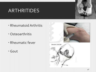 ARTHRITIDES
 Rheumatoid Arthritis
 Osteoarthritis
 Rheumatic fever
 Gout

46

 