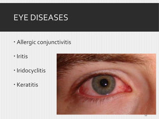 EYE DISEASES
 Allergic conjunctivitis
 Iritis
 Iridocyclitis
 Keratitis

53

 
