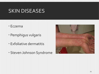 SKIN DISEASES
 Eczema
 Pemphigus vulgaris
 Exfoliative dermatitis
 Steven Johnson Syndrome

54

 