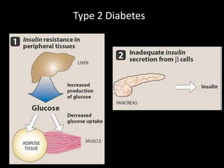 Type 2 Diabetes 