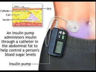 Indications of insulin in type II DMPrimary or secondary failure of oral hypoglycemicsPregnancyPerioperative period CKDSteroid therapyLADAFasting > 300 mgms HbA1c > 10Unintentional wt loss with or with out ketosisType 2 with DKA ( severe beta cell dysfunction)