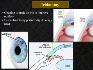 Iridotomy
Opening is made on iris to improve
outflow
Lasers Iridotomy perform-light energy
used
 