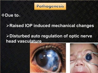 Due to:-
Raised IOP induced mechanical changes
Disturbed auto regulation of optic nerve
head vasculature
 