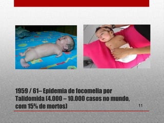 11
1959 / 61– Epidemia de focomelia por
Talidomida (4.000 – 10.000 casos no mundo,
com 15% de mortos)
 