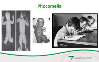Phocomelia
 
