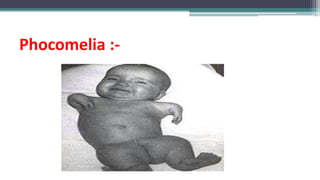 Phocomelia :-
 