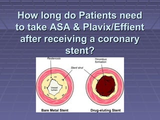 How long do Patients needHow long do Patients need
to take ASA & Plavix/Effientto take ASA & Plavix/Effient
after receiving a coronaryafter receiving a coronary
stent?stent?
 