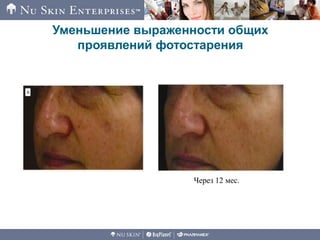 Уменьшение выраженности общих
проявлений фотостарения
Через 12 мес.
 