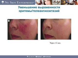 Уменьшение выраженности
эритемы/телеангиоэктазий
Через 12 мес.
 