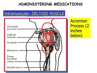 ADMINISTERING MEDICATIONS Intramuscular: DELTOID MUSCLE Acromion Process (2 inches below) 