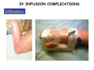 Infiltration: IV INFUSION COMPLICATIONS 
