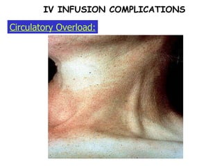 Circulatory Overload: IV INFUSION COMPLICATIONS 