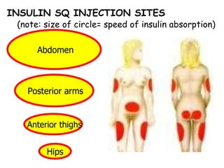 Abdomen  Anterior thighs Hips  Posterior arms  INSULIN SQ INJECTION SITES  (note: size of circle= speed of insulin absorption) 