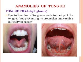 ANAMOLIES OF TONGUE
TONGUE TIE(Ankyloglossia)
 Due to frenulum of tongue extends to the tip of the
tongue, thus preventing its protrusion and causing
difficulty in speech
 