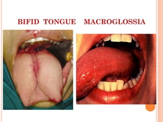 BIFID TONGUE MACROGLOSSIA
 